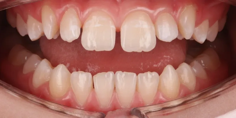 Răng cửa thưa nhân tướng học giải mã