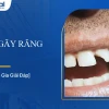 Mơ thấy gãy răng là điềm báo gì? Giải mã giấc mơ chi tiết 2026
