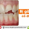 Rụng răng là điềm gì? Giải mã giấc mơ và ý nghĩa tâm linh