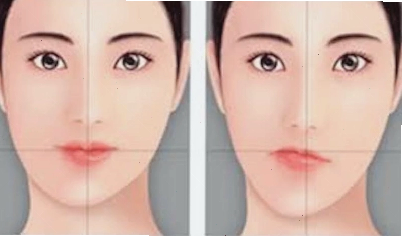 Cằm lệch có thể ảnh hưởng đến sự hài hòa của khuôn mặt