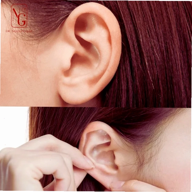 Chi tiết tướng tai với vành tai lồi ra ngoài