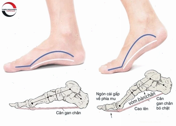 Coi tướng bàn chân nam với nốt ruồi son ở lòng bàn chân