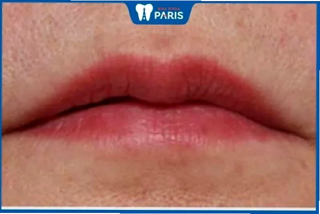 Đàn ông với đôi môi thâm