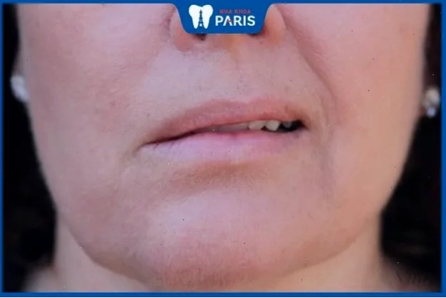 Đàn ông với tướng môi lệch