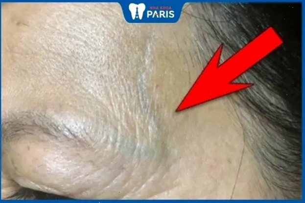 Gân nổi trên trán có thể là dấu hiệu của áp lực và căng thẳng