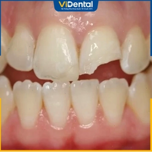 Giấc mơ gãy răng cửa và ý nghĩa tâm lý