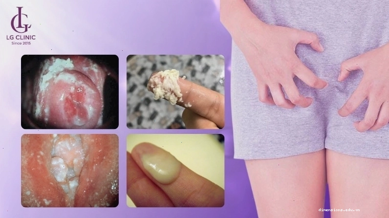 Nấm vùng kín ở giai đoạn nặng