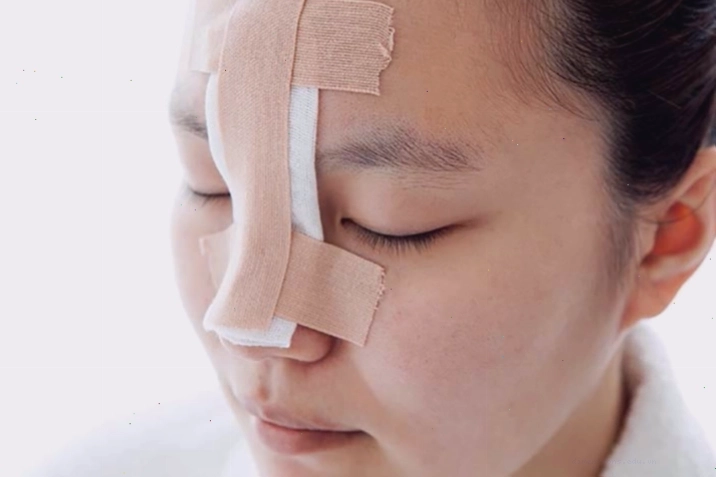 Nâng mũi bằng công nghệ tiên tiến để có được tướng mũi giàu sang