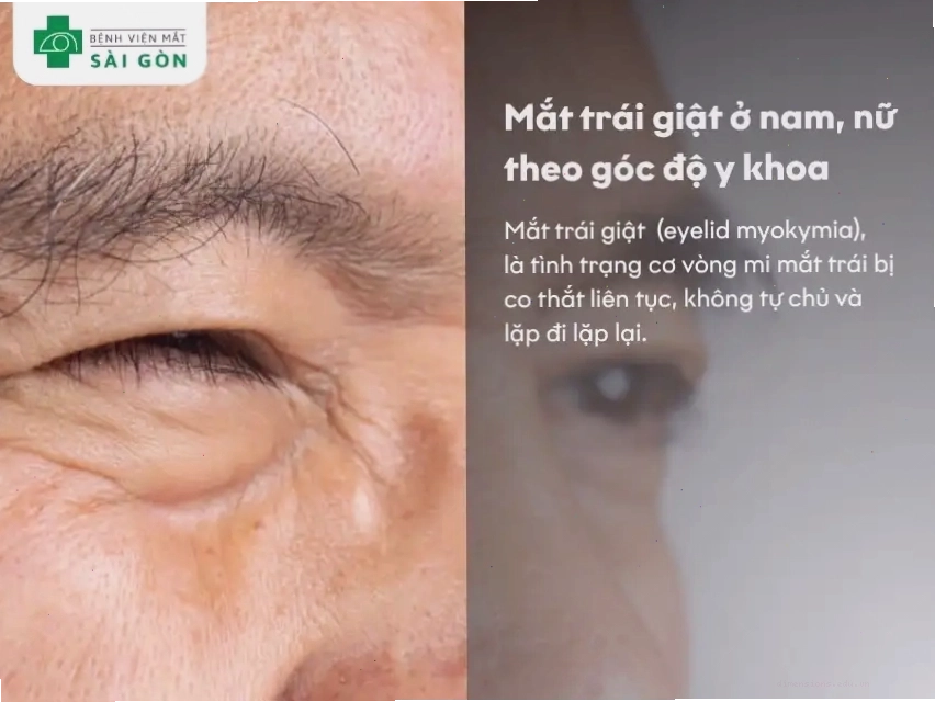 Nguyên nhân mắt trái nam giật theo định nghĩa y khoa