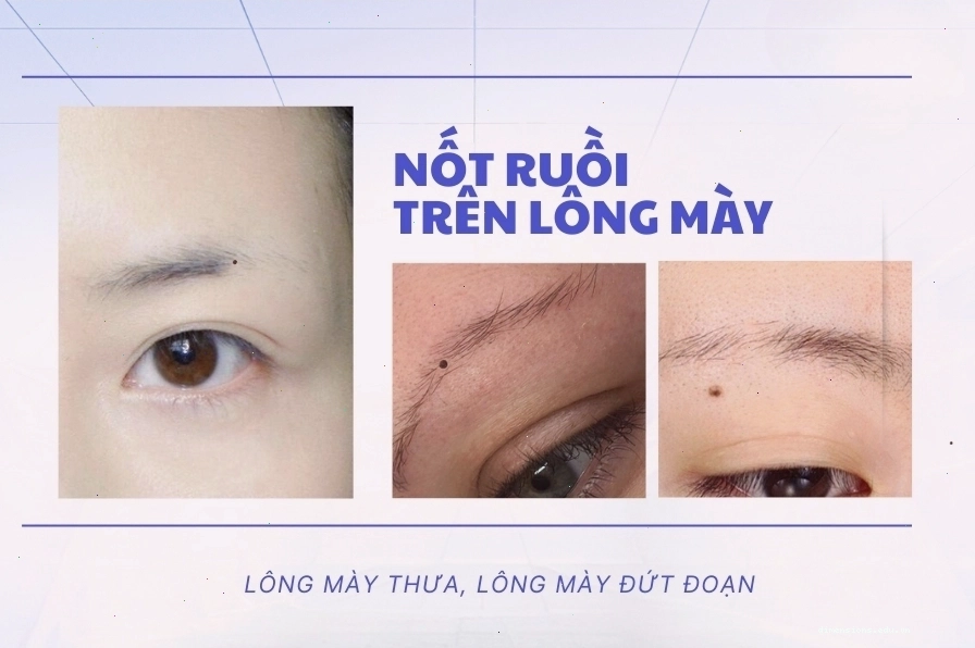 Nốt ruồi trên lông mày nam giới