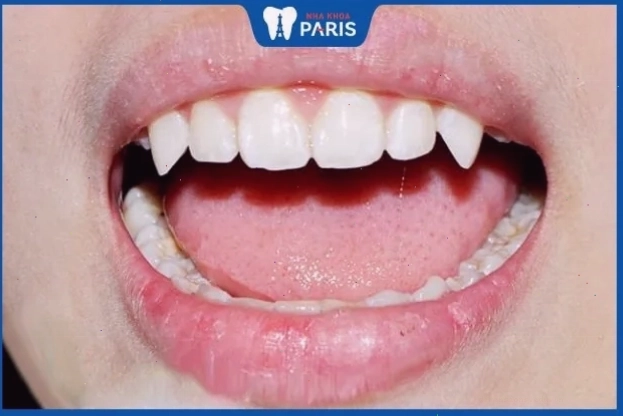 Phụ nữ có tướng răng chó thường gặp khó khăn trong chuyện tình duyên