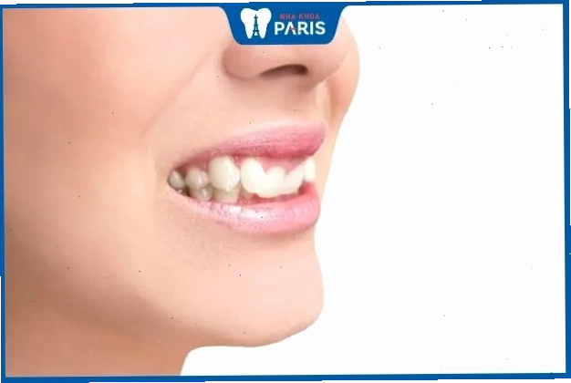 Phụ nữ có tướng răng khấp khểnh thường có tính cách thất thường