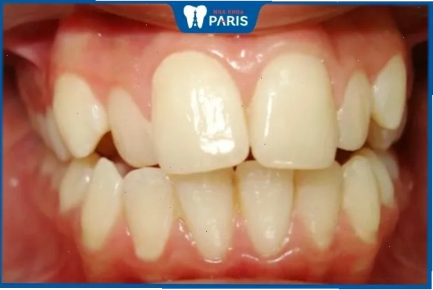 Phụ nữ răng cửa thưa thường rộng rãi, phóng khoáng và thiếu cân nhắc chi tiêu