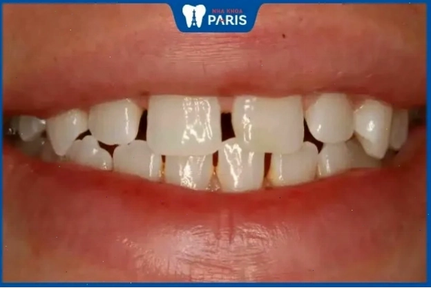 Phụ nữ răng hô vẩu thường nóng nảy và thiếu kiên nhẫn