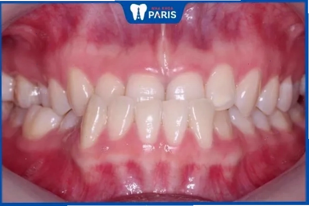 Phụ nữ răng quặp hoặc móm thường bảo thủ và hay lo lắng