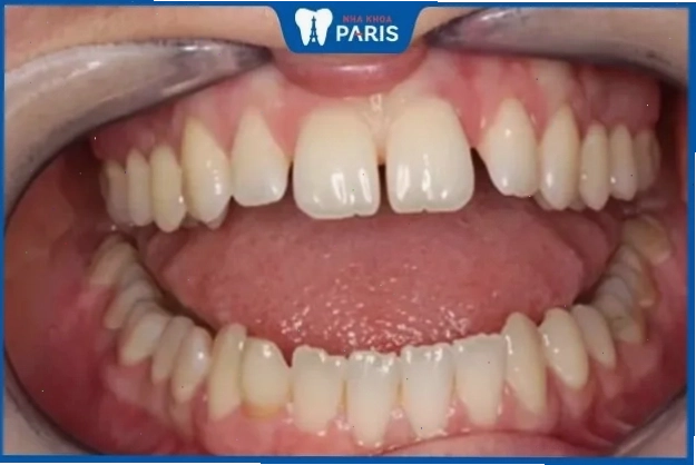 Phụ nữ răng thưa toàn hàm thường thoáng đạt, coi trọng bạn bè