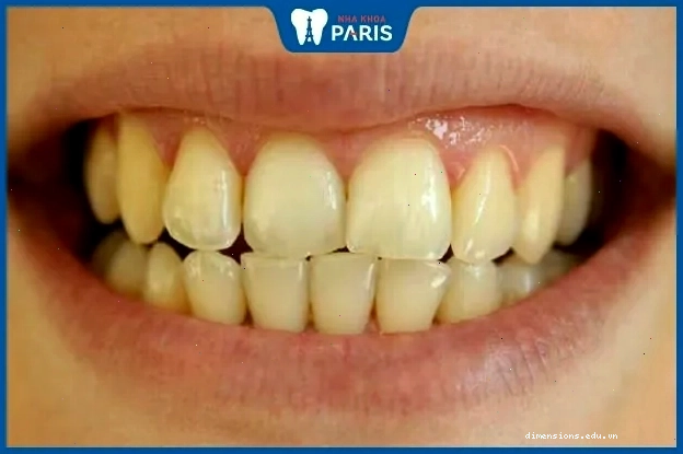 Răng nhỏ thể hiện tính cách thực dụng, răng thô to có thể thiếu tế nhị