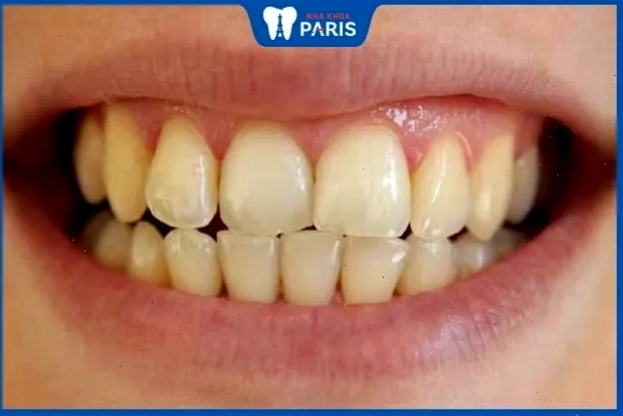 Răng ố vàng xỉn màu ở đàn ông