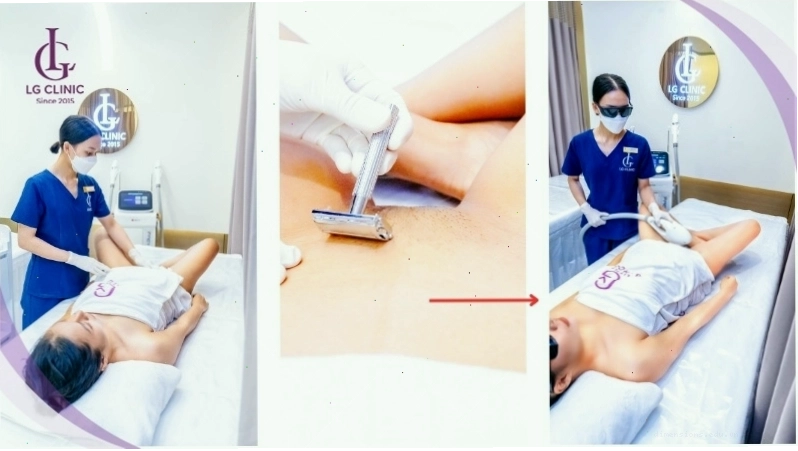 Triệt lông mu vĩnh viễn bằng công nghệ LG Cool Hybrid tại Viện thẩm mỹ LG Clinic