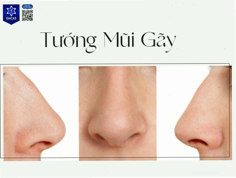 Tướng mũi gãy ở nam giới