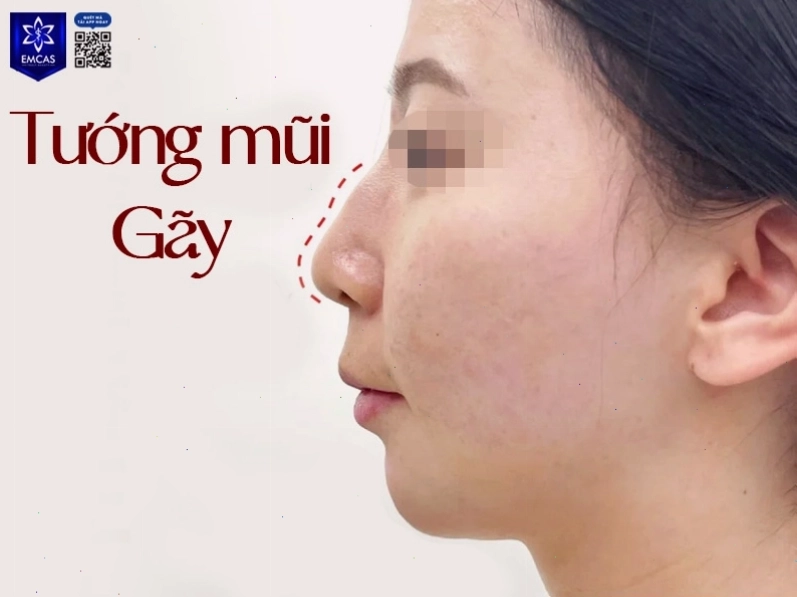 Tướng mũi gãy với điểm lồi trên sống mũi