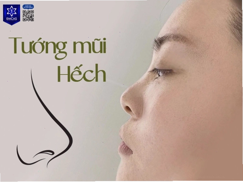 Tướng mũi hếch để lộ lỗ mũi