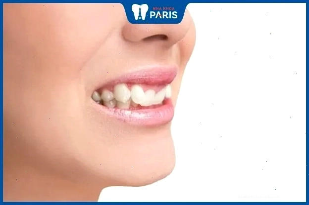 Tướng răng khấp khểnh