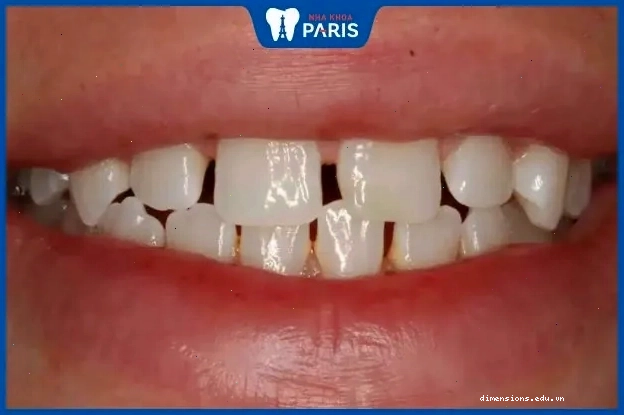 Tướng răng thưa ở đàn ông