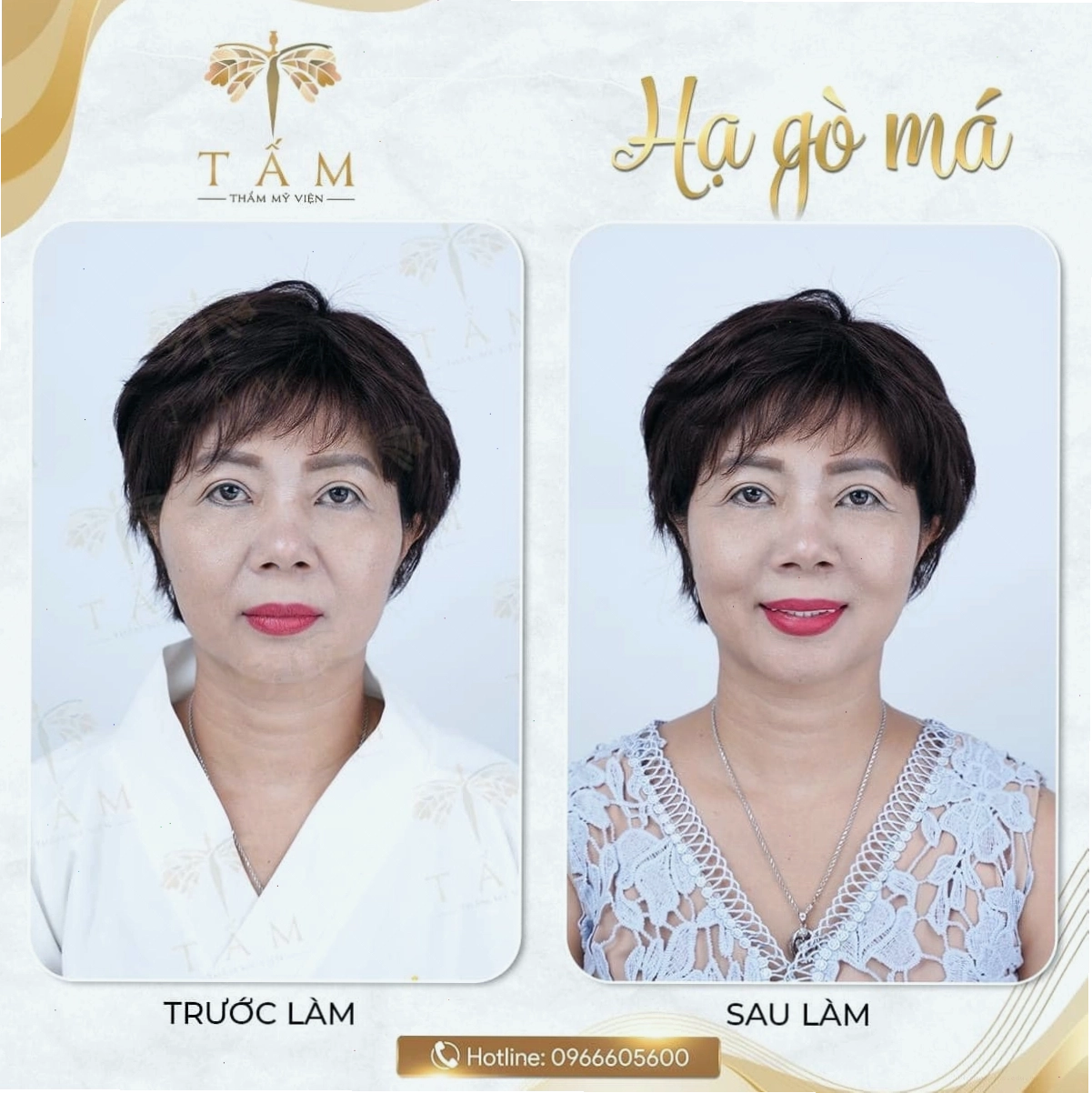 Vị trí nốt ruồi trên cằm mang những ý nghĩa phong thủy khác nhau