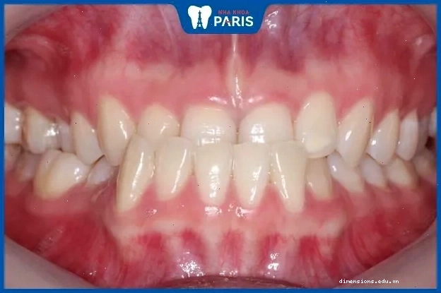 Xem tướng răng móm
